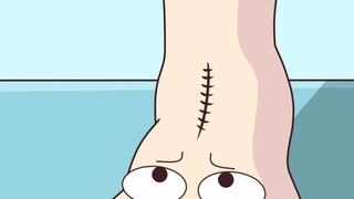 Ankle fusion