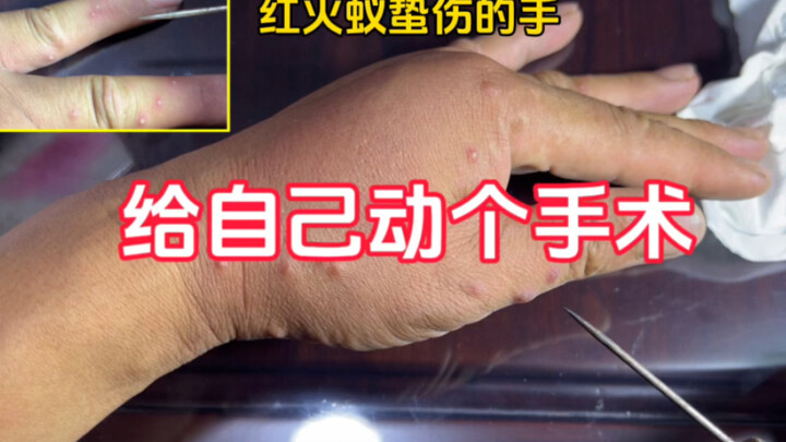What happened when Xiao He challenged red fire ants: his hand swelled up from their stings, and now 