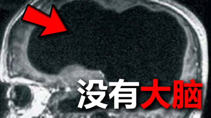 这个人，大脑消失了