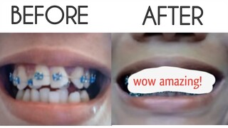 BRACES TIME LAPSE ( March 2017 to March 2019)