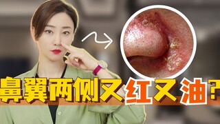 Sayap hidung kiri dan kanan merah dan berminyak, apa yang harus dilakukan?