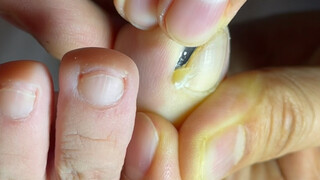 Good news for obsessive-compulsive disorder!