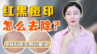 Bagaimana cara mengatasi bekas jerawat merah dan hitam? Dokter kulit akan mengajarimu!