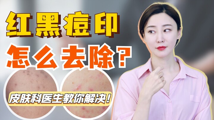 Bagaimana cara mengatasi bekas jerawat merah dan hitam? Dokter kulit akan mengajarimu!