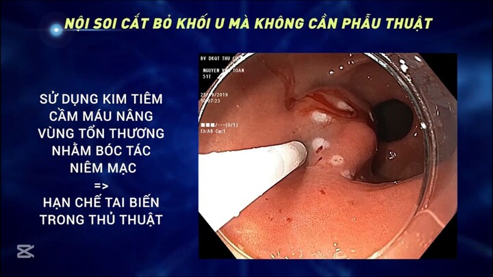 Cắt u không phẫu thuật và lấy dị vật