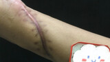 The scars that were sutured more than ten years ago seriously affected the appearance, so the young 