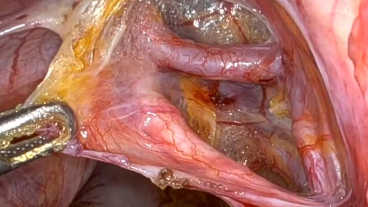 Under laparoscopy, let's take a close look at the real appearance of the ureter.