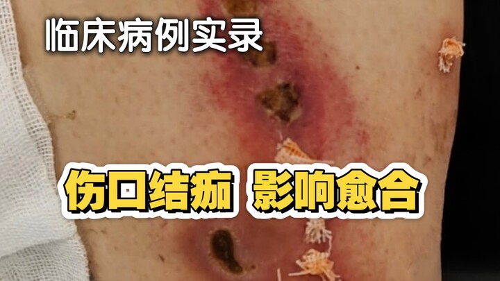 Scab formation is a factor that hinders wound healing!