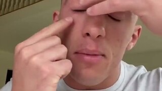 小哥2岁时因为癌症摘除了一只眼睛，当他戴上假眼球后，你根本看不出来