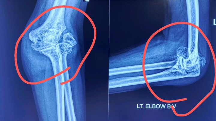 What Happens When an Elbow Fracture Never Heals? Non-Union & Osteoarthritis on X-ray