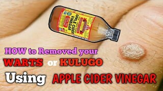 mabisang pang ALIS ng kulugo or wart APPLE CIDER VINEGAR.