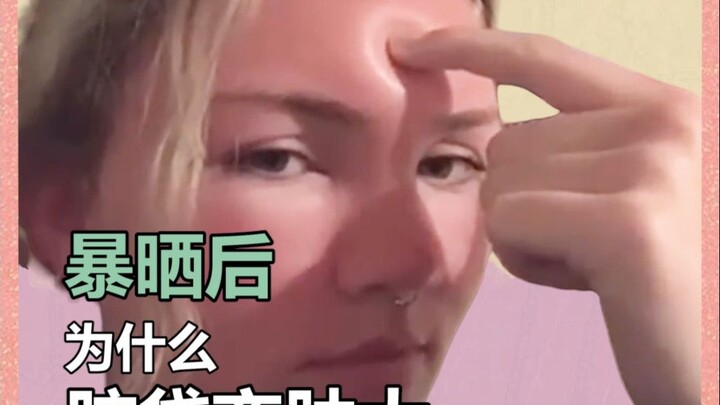 Sau khi phơi nắng, đầu bỗng sưng lên, chỉ cần chọc nhẹ là lõm xuống.