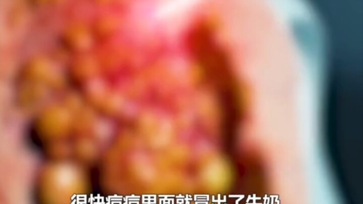 فيديو قصير مُريح للنفس: فتاة تعاني من "كيسة" تظهر عليها بثرة شباب ضخمة جدًا، ولحظة عصرها مُمتعة جدًا