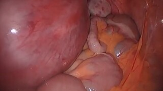 孕妇肚子里的阑尾发炎是什么样的？