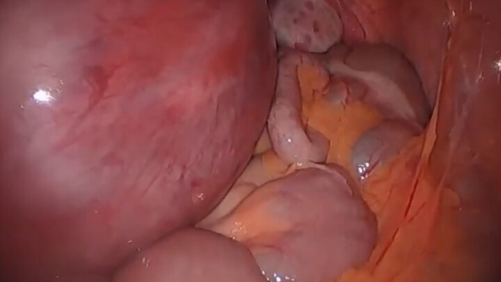 What does appendicitis feel like when you're pregnant?